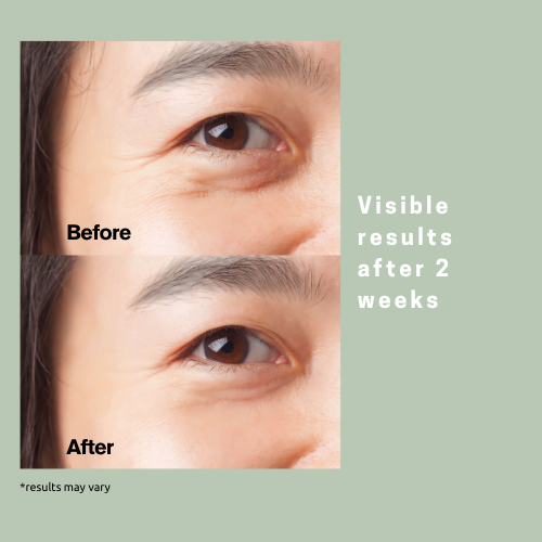Target Eye Wrinkles While You Sleep ✨ Microneedle Patches for under eye wrinkles