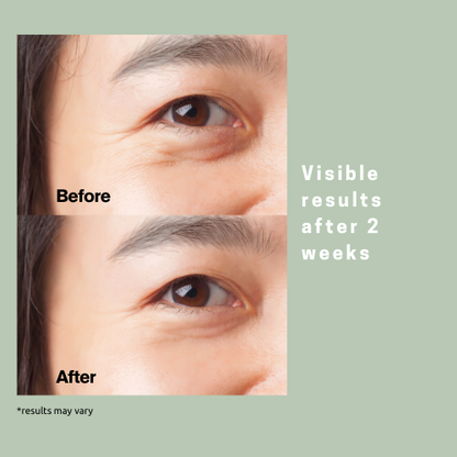 Target Eye Wrinkles While You Sleep ✨ Microneedle Patches for under eye wrinkles